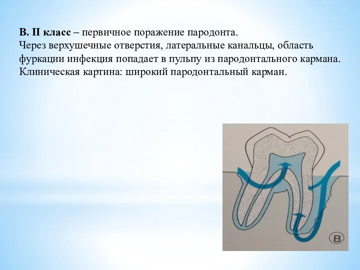 В. II класс – первичное поражение пародонта. Через верхушечные отверстия,