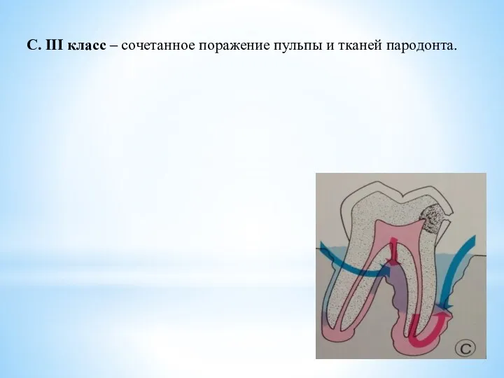 С. III класс – сочетанное поражение пульпы и тканей пародонта.