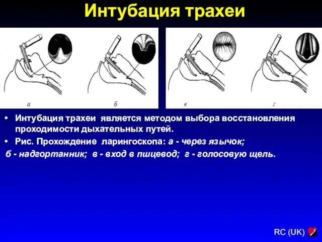 Интубация трахеи Интубация трахеи является методом выбора восстановления проходимости дыхательных