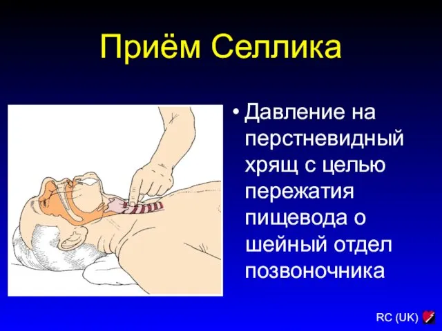 Давление на перстневидный хрящ с целью пережатия пищевода о шейный отдел позвоночника Приём Селлика