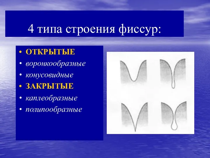 4 типа строения фиссур: ОТКРЫТЫЕ воронкообразные конусовидные ЗАКРЫТЫЕ каплеобразные полипообразные