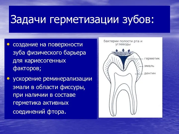 Задачи герметизации зубов: создание на поверхности зуба физического барьера для