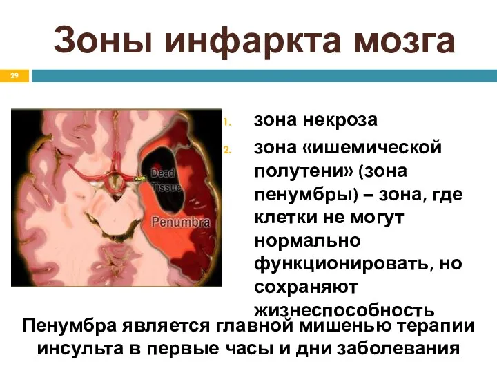 Зоны инфаркта мозга зона некроза зона «ишемической полутени» (зона пенумбры)