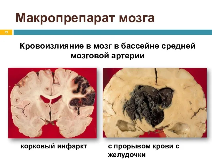 Макропрепарат мозга Кровоизлияние в мозг в бассейне средней мозговой артерии