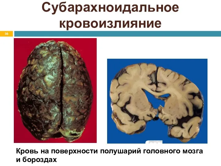 Субарахноидальное кровоизлияние Кровь на поверхности полушарий головного мозга и бороздах