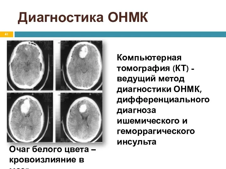 Диагностика ОНМК Компьютерная томография (КТ) - ведущий метод диагностики ОНМК, дифференциального диагноза ишемического