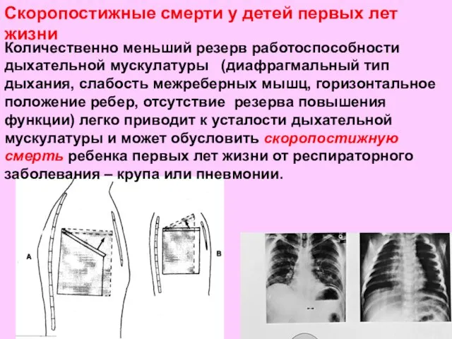 Количественно меньший резерв работоспособности дыхательной мускулатуры (диафрагмальный тип дыхания, слабость межреберных мышц, горизонтальное