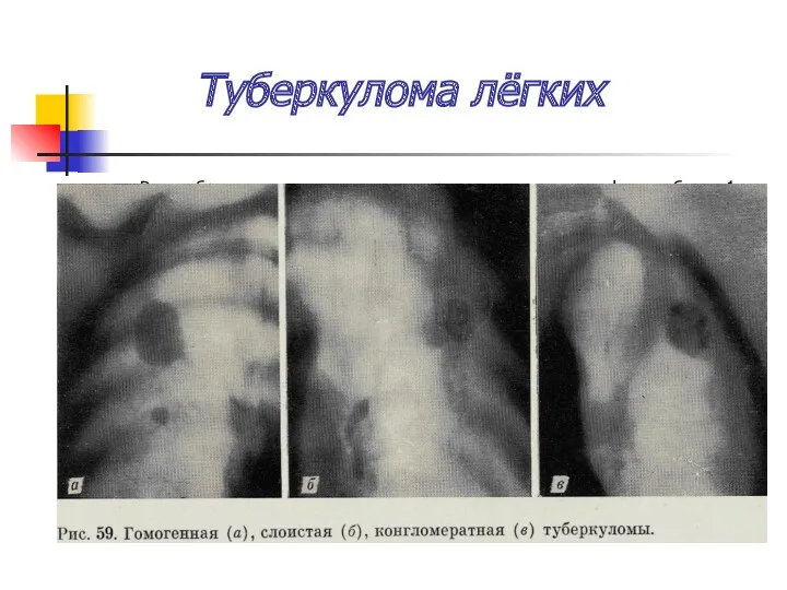 Туберкулома лёгких Разнообразные по генезу инкапсулированные казеозные фокусы более 1
