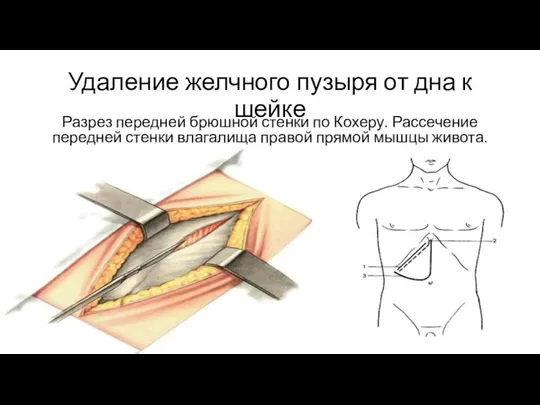 Удаление желчного пузыря от дна к шейке Разрез передней брюшной