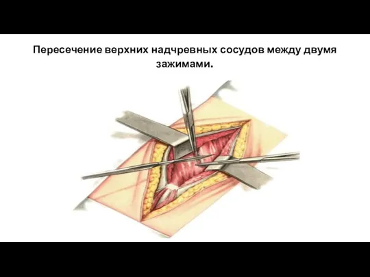 Пересечение верхних надчревных сосудов между двумя зажимами.