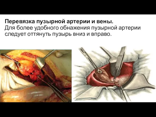 Перевязка пузырной артерии и вены. Для более удобного обнажения пузырной