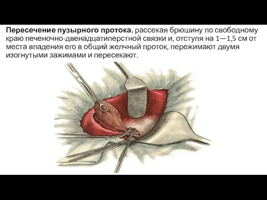 Пересечение пузырного протока. рассекая брюшину по свободному краю печеночно-двенадцатиперстной связки