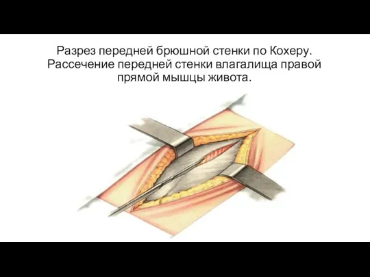 Разрез передней брюшной стенки по Кохеру. Рассечение передней стенки влагалища правой прямой мышцы живота.