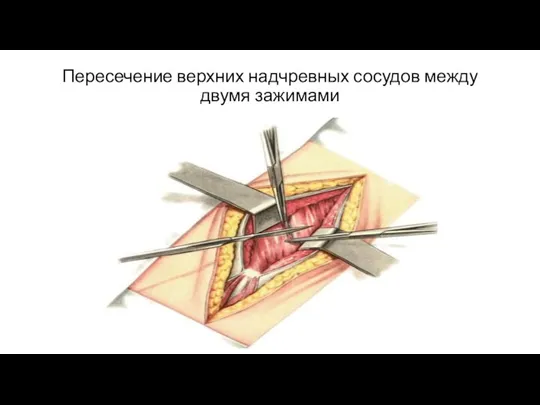 Пересечение верхних надчревных сосудов между двумя зажимами