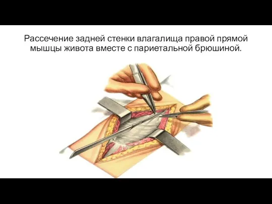 Рассечение задней стенки влагалища правой прямой мышцы живота вместе с париетальной брюшиной.