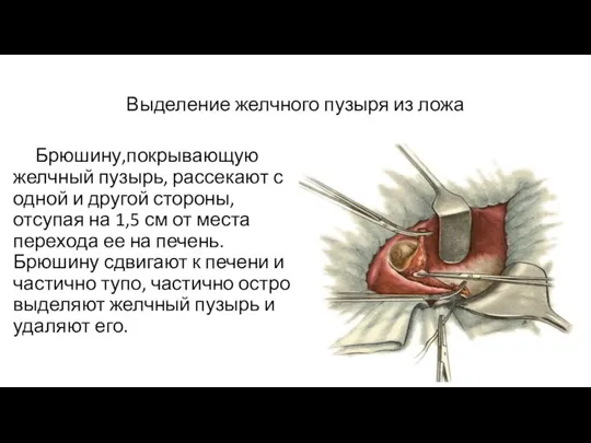 Выделение желчного пузыря из ложа Брюшину,покрывающую желчный пузырь, рассекают с