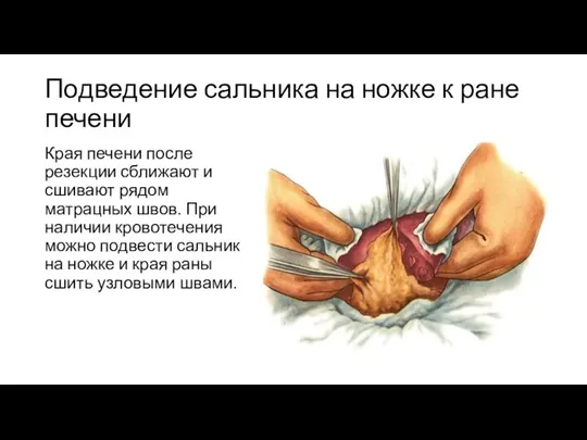 Подведение сальника на ножке к ране печени Края печени после