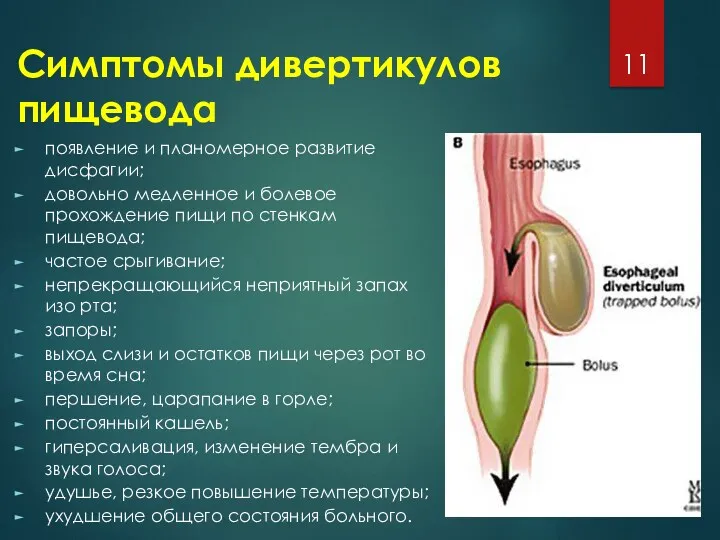 Симптомы дивертикулов пищевода появление и планомерное развитие дисфагии; довольно медленное