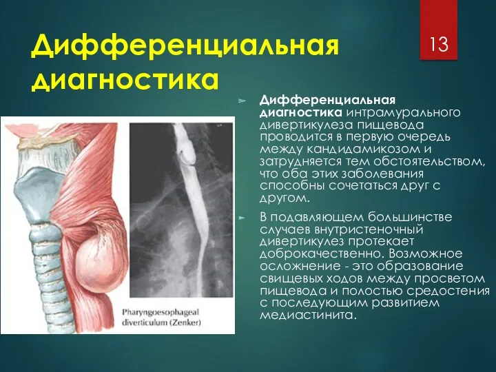 Дифференциальная диагностика Дифференциальная диагностика интрамурального дивертикулеза пищевода проводится в первую