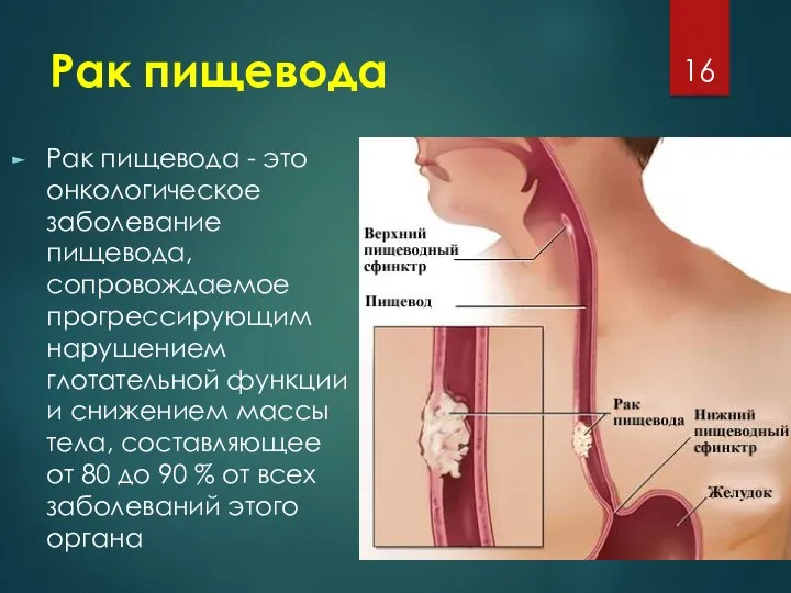 Рак пищевода Рак пищевода - это онкологическое заболевание пищевода, сопровождаемое