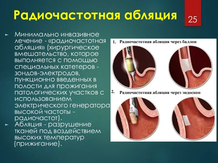 Радиочастотная абляция Минимально инвазивное лечение - «радиочастотная абляция» (хирургическое вмешательство,