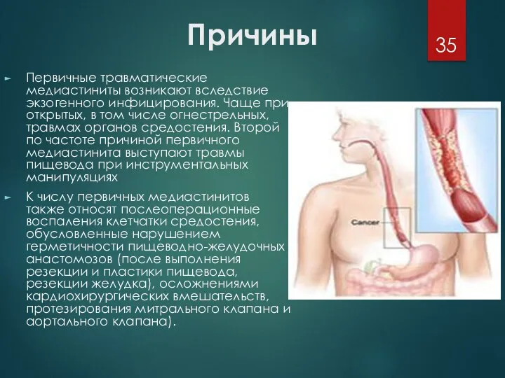 Причины Первичные травматические медиастиниты возникают вследствие экзогенного инфицирования. Чаще при