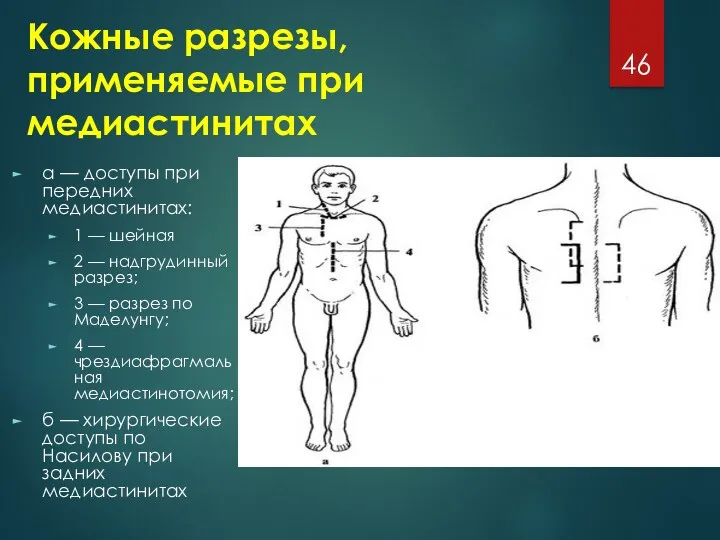 Кожные разрезы, применяемые при медиастинитах а — доступы при передних