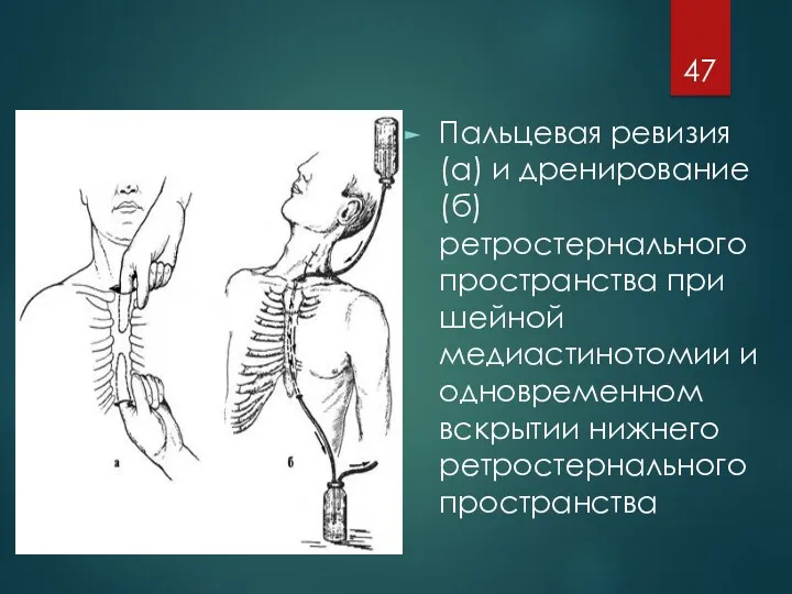 Пальцевая ревизия (а) и дренирование (б) ретростернального пространства при шейной