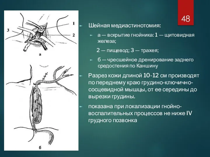 Шейная медиастинотомия: а — вскрытие гнойника: 1 — щитовидная железа;