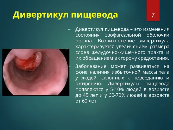 Дивертикул пищевода Дивертикул пищевода – это изменения состояния эзофагеальной оболочки