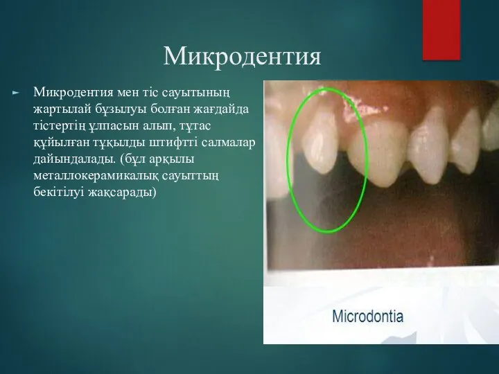 Микродентия Микродентия мен тіс сауытының жартылай бұзылуы болған жағдайда тістертің