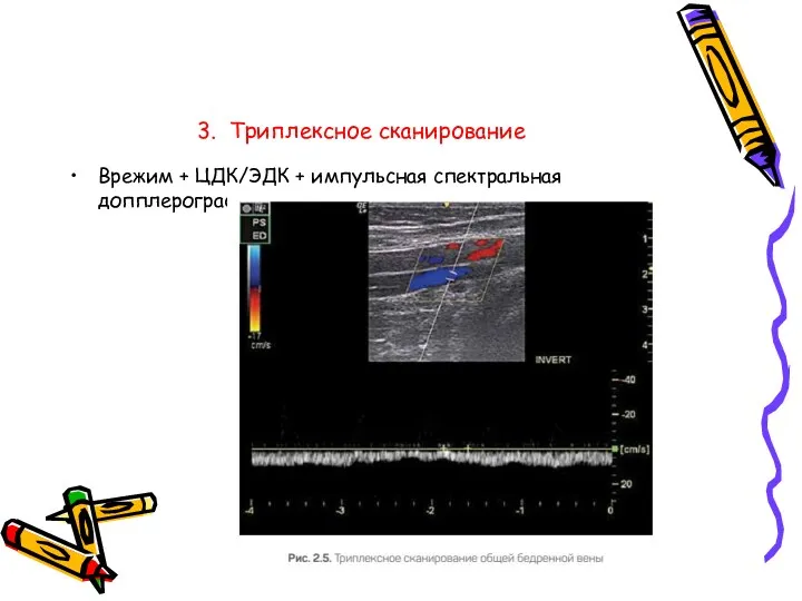 3. Триплексное сканирование В­режим + ЦДК/ЭДК + импульсная спектральная допплерография