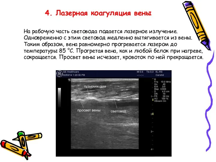 4. Лазерная коагуляция вены На рабочую часть световода подается лазерное