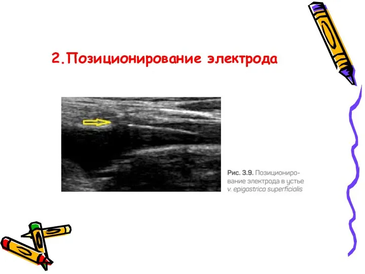 2.Позиционирование электрода