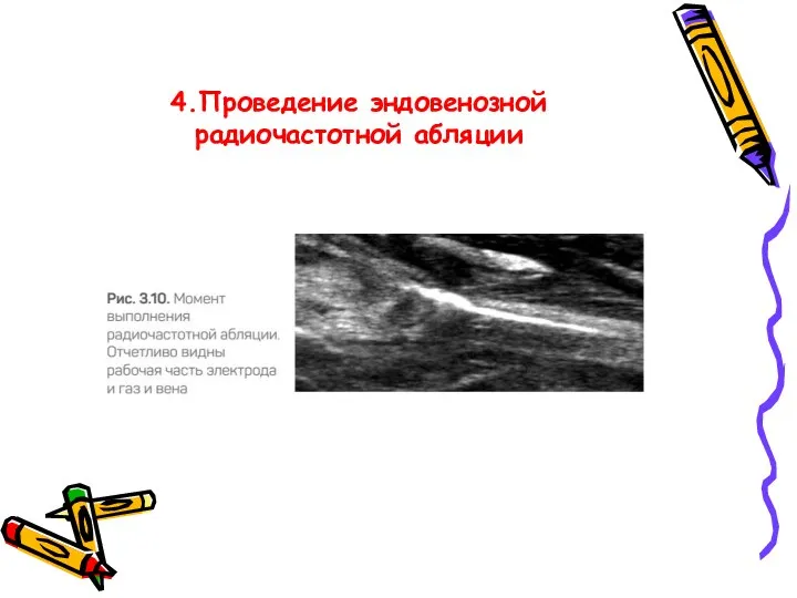 4.Проведение эндовенозной радиочастотной абляции