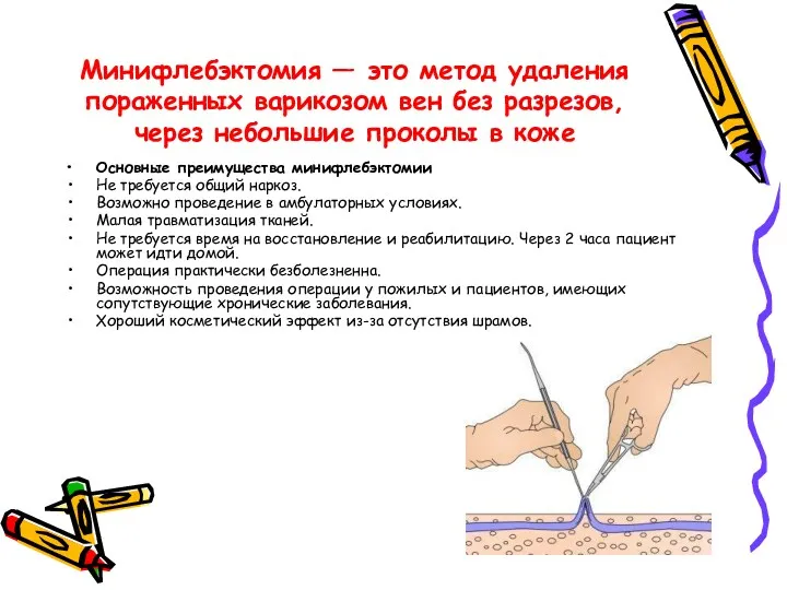 Минифлебэктомия — это метод удаления пораженных варикозом вен без разрезов,