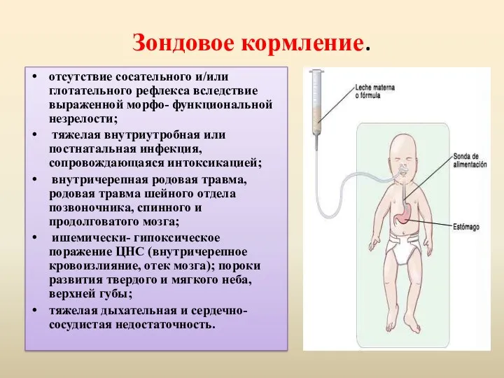 Зондовое кормление. отсутствие сосательного и/или глотательного рефлекса вследствие выраженной морфо-