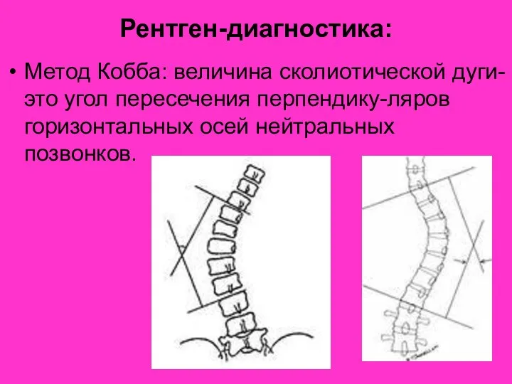 Рентген-диагностика: Метод Кобба: величина сколиотической дуги- это угол пересечения перпендику-ляров горизонтальных осей нейтральных позвонков.