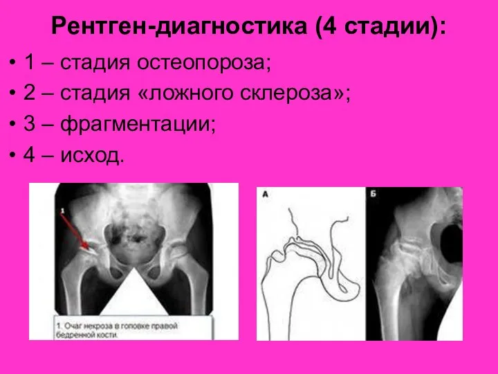 Рентген-диагностика (4 стадии): 1 – стадия остеопороза; 2 – стадия
