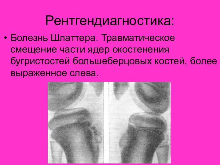 Рентгендиагностика: Болезнь Шлаттера. Травматическое смещение части ядер окостенения бугристостей большеберцовых костей, более выраженное слева.