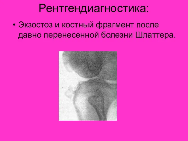 Рентгендиагностика: Экзостоз и костный фрагмент после давно перенесенной болезни Шлаттера.