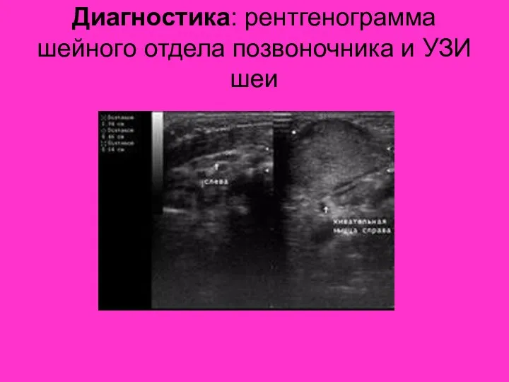 Диагностика: рентгенограмма шейного отдела позвоночника и УЗИ шеи