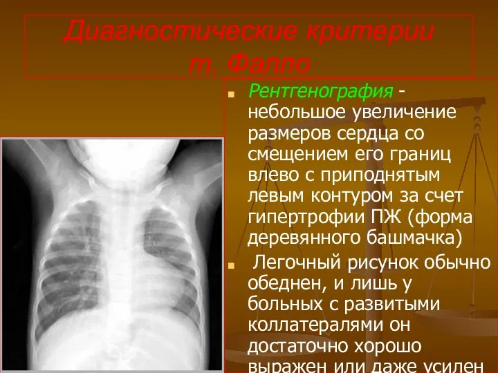 Диагностические критерии т. Фалло Рентгенография - небольшое увеличение размеров сердца