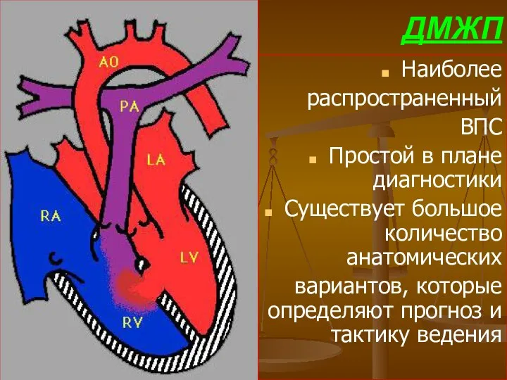 ДМЖП Наиболее распространенный ВПС Простой в плане диагностики Существует большое