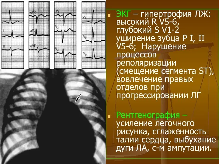 ЭКГ – гипертрофия ЛЖ: высокий R V5-6, глубокий S V1-2