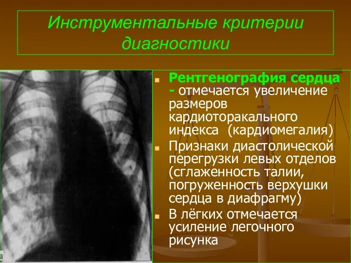 Инструментальные критерии диагностики Рентгенография сердца - отмечается увеличение размеров кардиоторакального