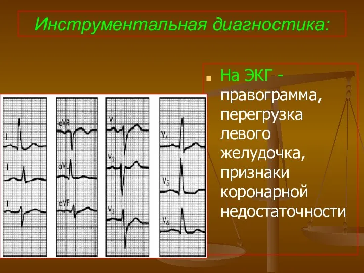 Инструментальная диагностика: На ЭКГ - правограмма, перегрузка левого желудочка, признаки коронарной недостаточности