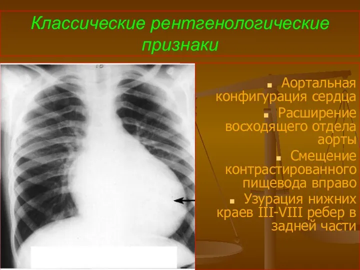 Классические рентгенологические признаки Аортальная конфигурация сердца Расширение восходящего отдела аорты