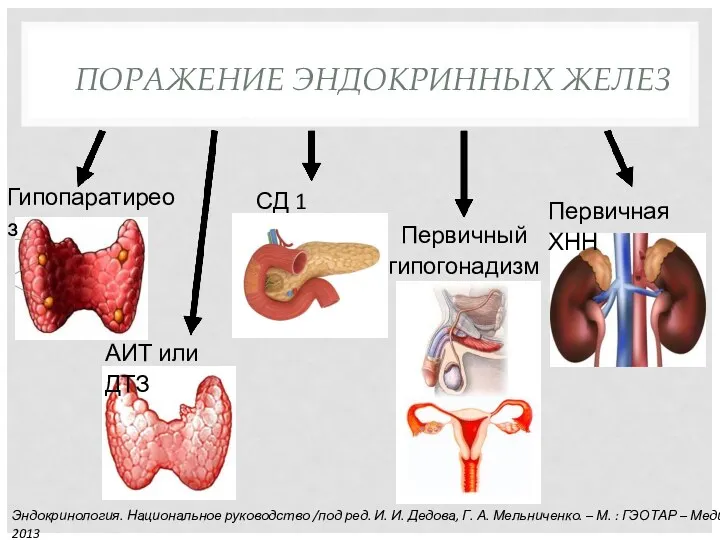 ПОРАЖЕНИЕ ЭНДОКРИННЫХ ЖЕЛЕЗ Гипопаратиреоз АИТ или ДТЗ СД 1 типа