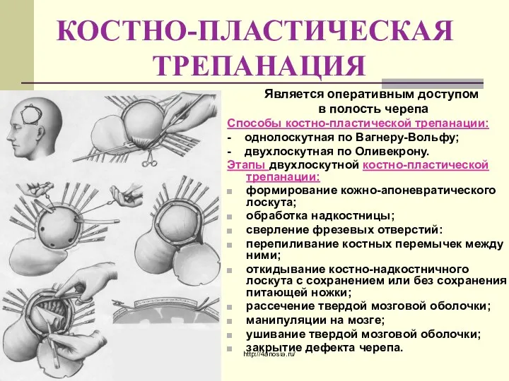 КОСТНО-ПЛАСТИЧЕСКАЯ ТРЕПАНАЦИЯ Является оперативным доступом в полость черепа Способы костно-пластической